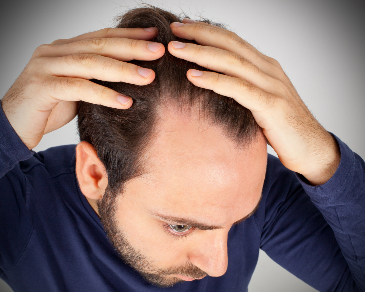 What Causes Hair Loss in Men: 6 Common Causes & What You Can Do About It