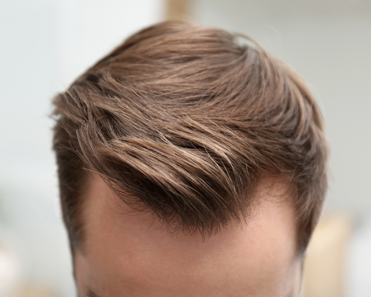 receding hairline
