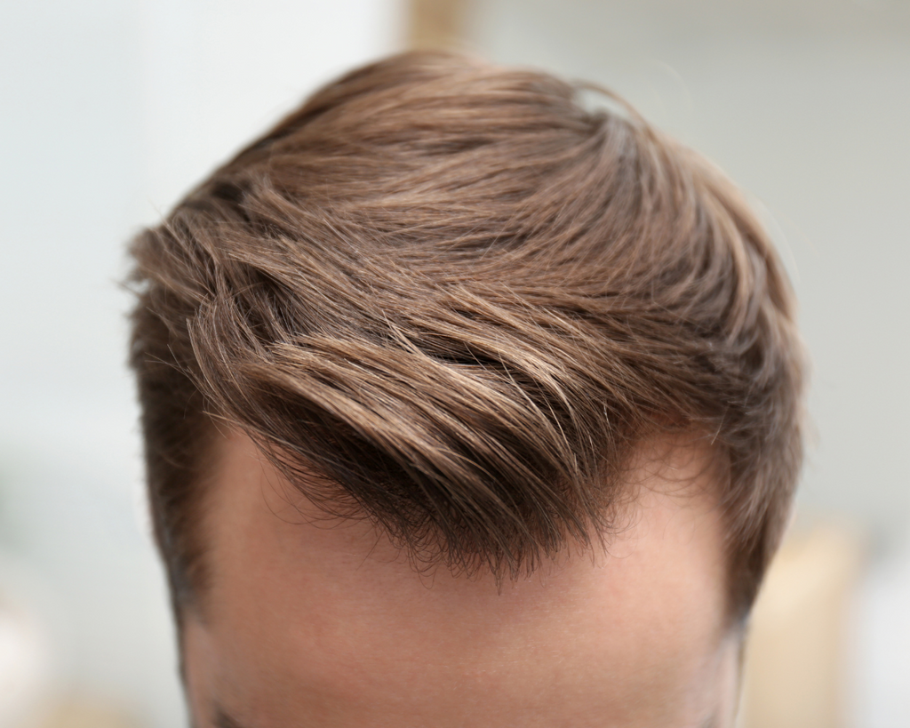 Receding hairline hotsell