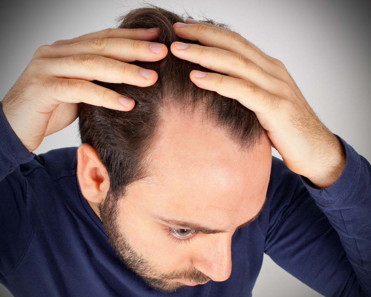 What Causes Hair Loss in Men: 6 Common Causes & What You Can Do About It